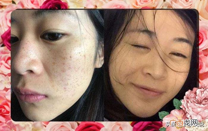 奢侈护肤和光子美白谁优谁劣 光子嫩肤可以美白吗