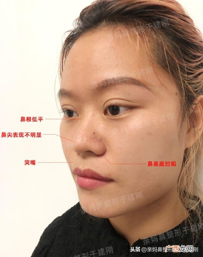 蒜头鼻巧变高挺模特鼻 蒜头鼻整形对比照片