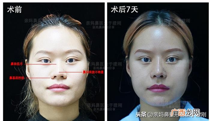 蒜头鼻巧变高挺模特鼻 蒜头鼻整形对比照片