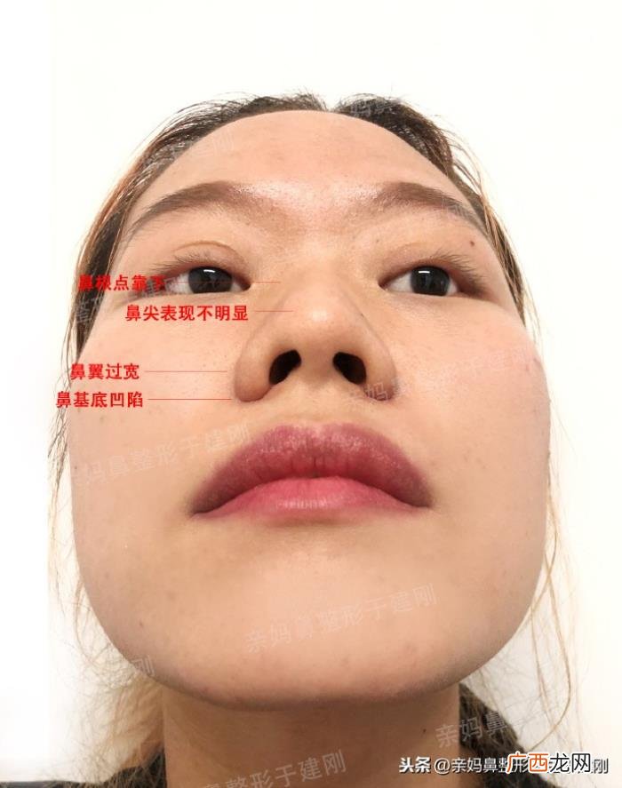 蒜头鼻巧变高挺模特鼻 蒜头鼻整形对比照片