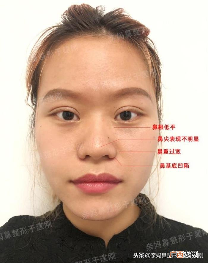 蒜头鼻巧变高挺模特鼻 蒜头鼻整形对比照片