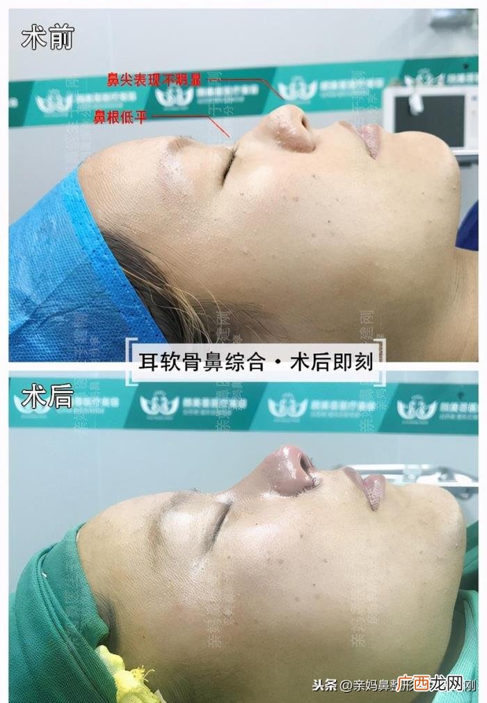 蒜头鼻巧变高挺模特鼻 蒜头鼻整形对比照片