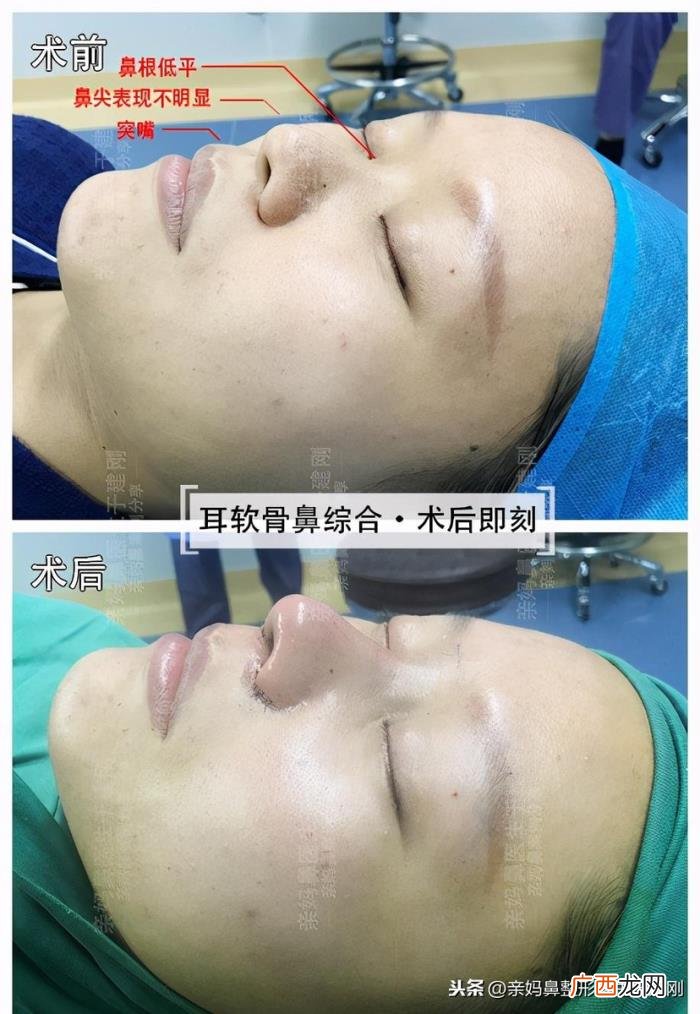 蒜头鼻巧变高挺模特鼻 蒜头鼻整形对比照片
