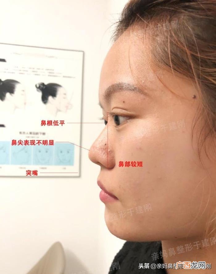 蒜头鼻巧变高挺模特鼻 蒜头鼻整形对比照片