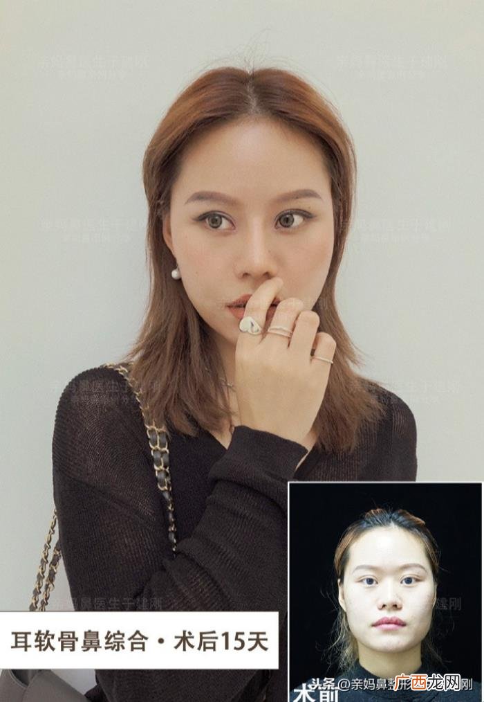 蒜头鼻巧变高挺模特鼻 蒜头鼻整形对比照片