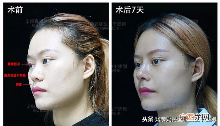 蒜头鼻巧变高挺模特鼻 蒜头鼻整形对比照片