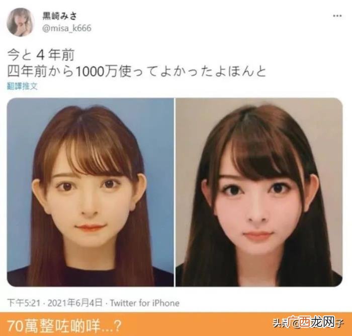 4年花58万整容整了个寂寞 斯容整容前后