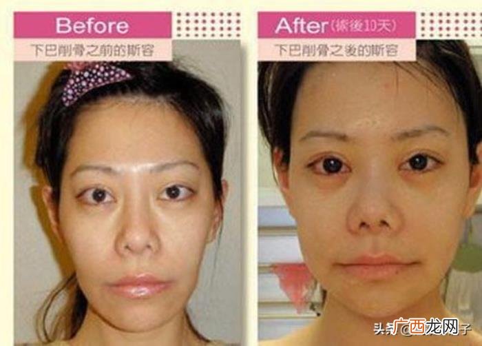 4年花58万整容整了个寂寞 斯容整容前后