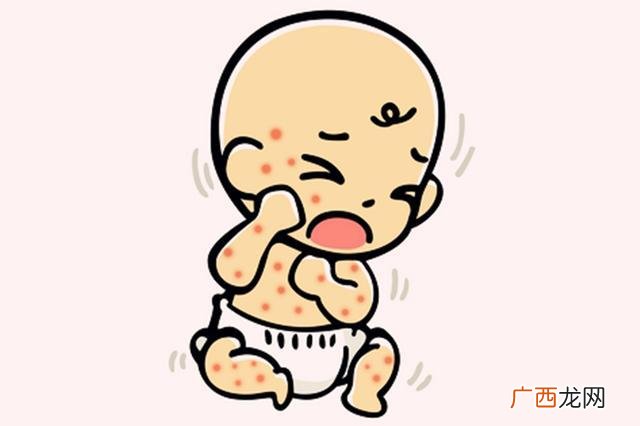 婴儿湿疹是什么原因引起的起的婴儿湿疹怎么护理好得快