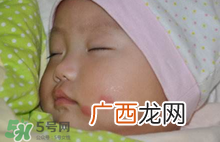 婴儿被蚊子咬了如何去红点？被蚊子咬后红点如何去除？