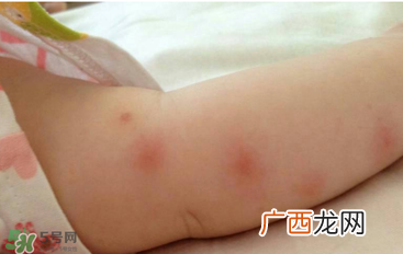 婴儿蚊子咬了怎么消肿?婴儿蚊子咬了怎么消肿止痒最快?