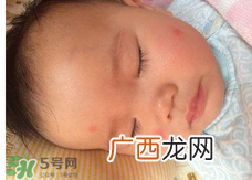 婴儿蚊子咬了怎么消肿?婴儿蚊子咬了怎么消肿止痒最快?