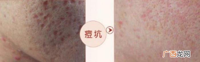这3种去痘疤的方法有效 快速去痘疤的方法