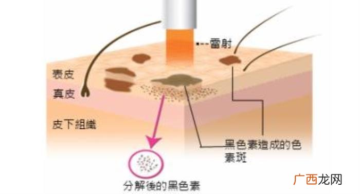 这3种去痘疤的方法有效 快速去痘疤的方法