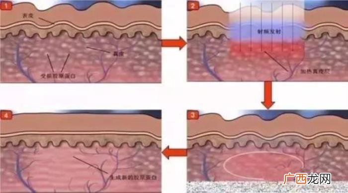 这3种去痘疤的方法有效 快速去痘疤的方法