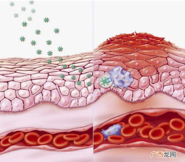 这3种去痘疤的方法有效 快速去痘疤的方法