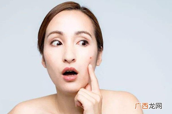 痘痘挤了之后能用芦荟胶吗及怎么用芦荟胶
