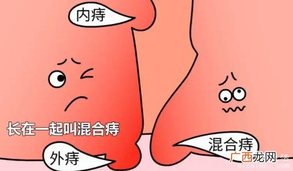 饮食清淡多喝水 内外痔疮最佳的自愈方法和治疗方法 冰幨抑菌凝胶治疗法
