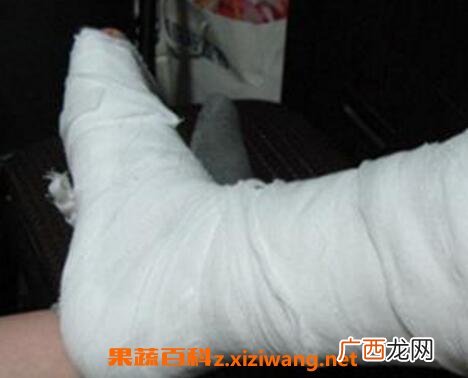 八仙接骨宝的配方与功效