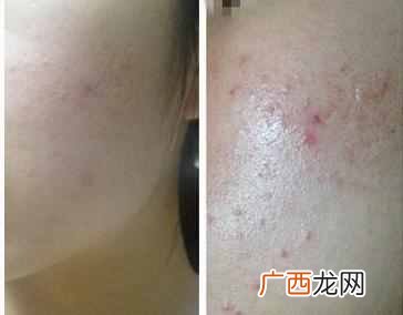 下巴上长痘痘是什么原因引起的（脸部长痘对应