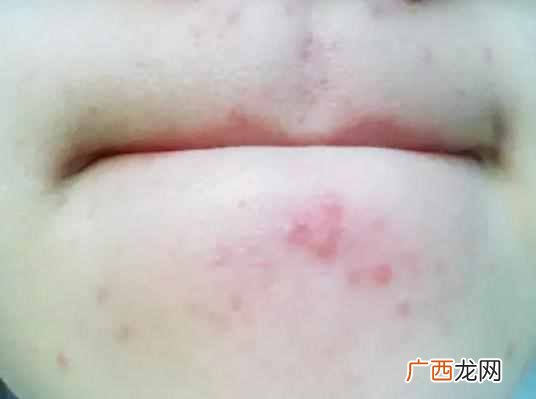 下巴上长痘痘是什么原因引起的（脸部长痘对应