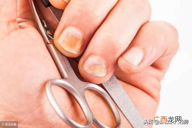 推荐几款最有效的药 灰指甲用什么药根除