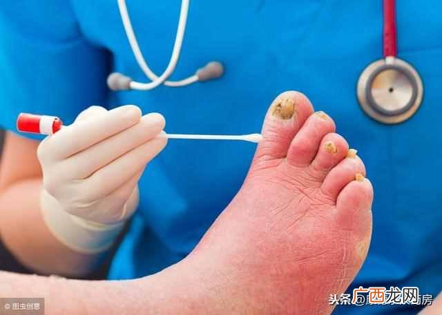 推荐几款最有效的药 灰指甲用什么药根除