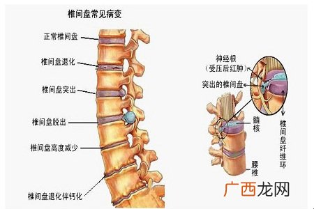中医教你推拿有效治疗缓解腰椎疼痛