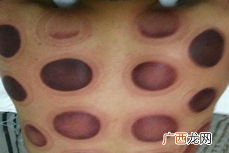 拔罐留下的印记有何含义?看印记辨别健康