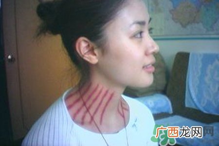 揪痧是什么？揪痧的好处有哪些？
