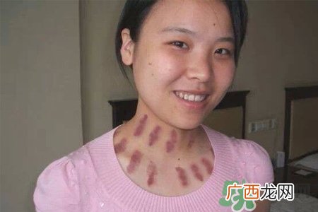 揪痧是什么？揪痧的好处有哪些？