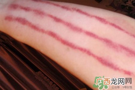 揪痧和刮痧哪个效果比较好？揪痧和刮痧的区别？