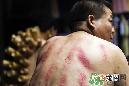 刮痧会得艾滋吗？刮痧会传染艾滋吗？
