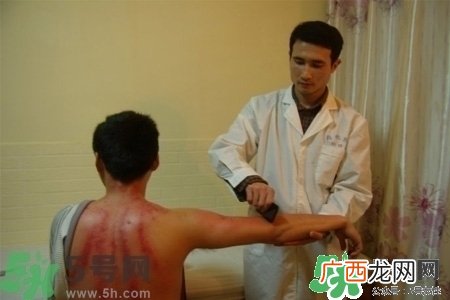刮痧能治疗风寒感冒吗？刮痧治疗风寒感冒效果好吗