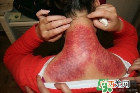 经常刮痧对身体好吗？经常刮痧拔罐对身体有什么坏处吗？