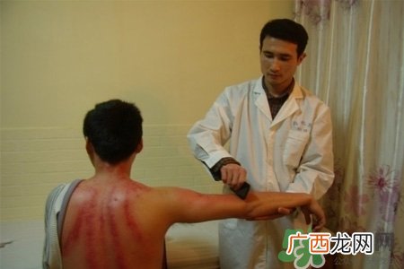 刮痧能去湿气吗？去湿气是拔罐好还是刮痧好？