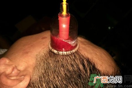 太阳穴可以拔火罐吗？偏头疼可以在太阳穴拔火罐吗？