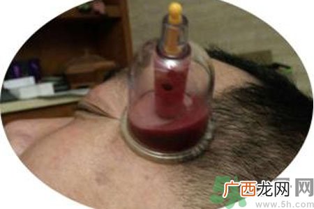 太阳穴可以拔火罐吗？偏头疼可以在太阳穴拔火罐吗？
