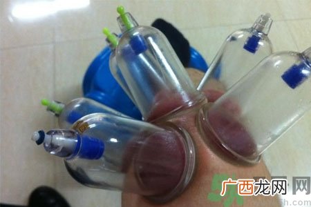 膝盖能拔罐吗？膝盖疼可以拔罐吗？