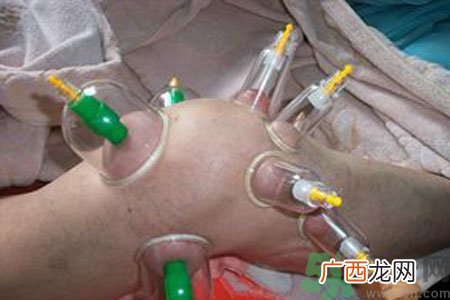 膝盖能拔罐吗？膝盖疼可以拔罐吗？