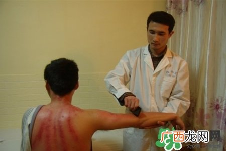 背部刮痧后能拔火罐吗？背部刮痧后拔火罐有什么好处？