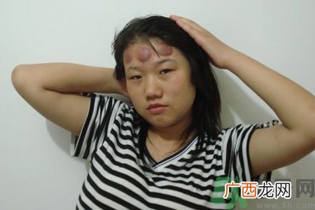 头痛可以在额头上拔火罐吗？额头上拔火罐有什么好处？