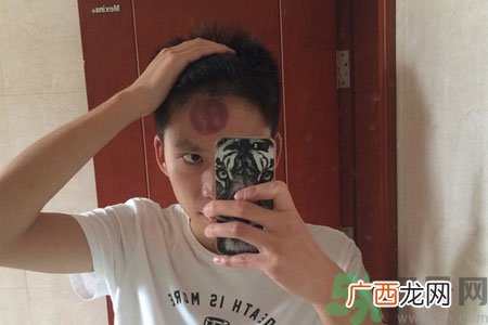 头痛可以在额头上拔火罐吗？额头上拔火罐有什么好处？