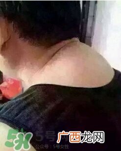 刮痧之后可以艾灸吗？刮痧之后可不可以艾灸