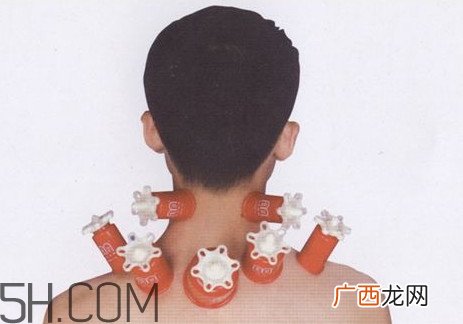 脖子可以刮痧吗？脖子拔火罐有什么好处