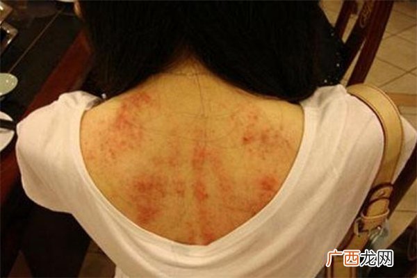 刮痧可以去火吗刮痧祛火方法