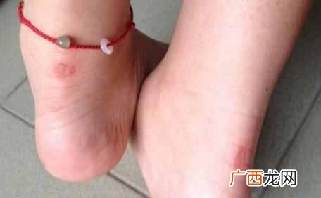 新买的鞋子磨脚怎么处理(如何解决鞋子磨脚问
