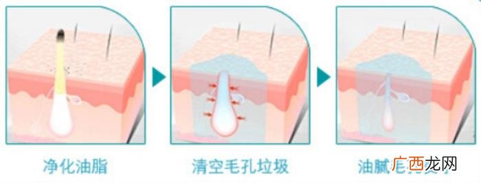 有人做过光子嫩肤吗 全身光子美白