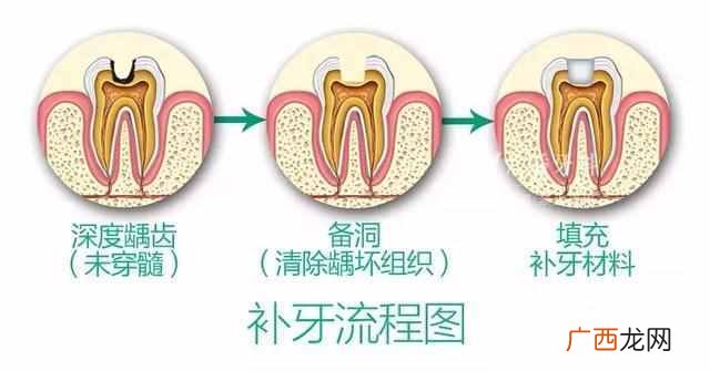 蛀牙老人补牙用什么材料好？补牙后一般能用几