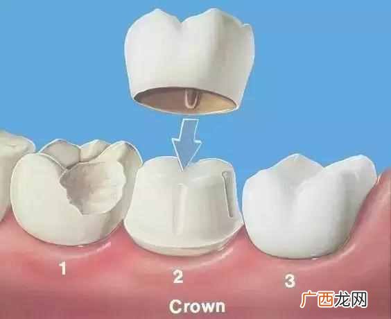 蛀牙老人补牙用什么材料好？补牙后一般能用几